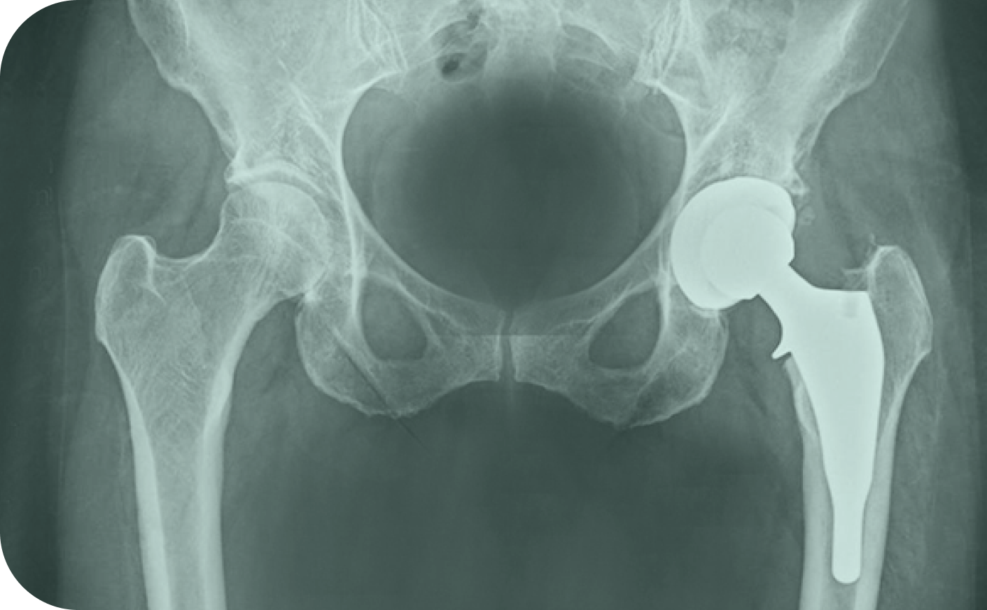 Ceramic Hip Replacements In West Sussex Mr Nirav Shah